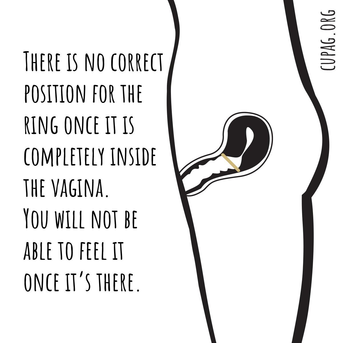 Illustration showing the ring sitting at the top of the vagina