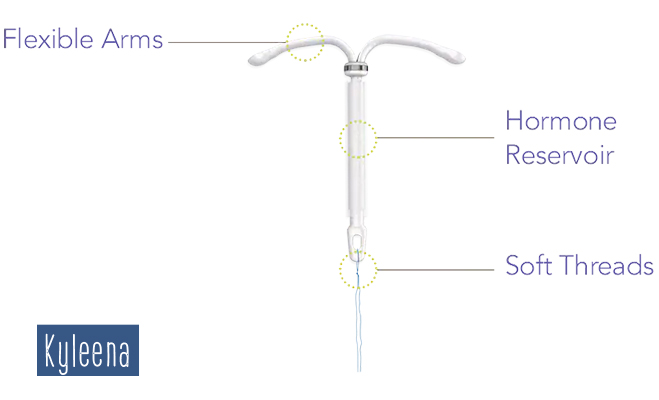 Image showing a Kyleena IUD including the flexible arms, hormone reservoir and soft threads